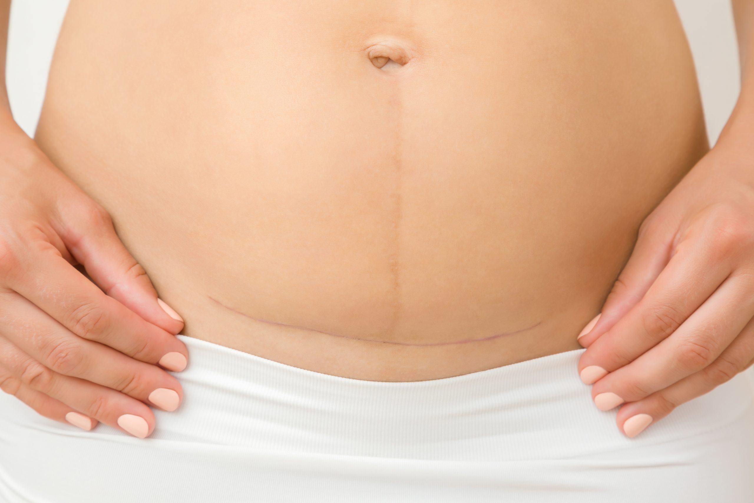 Woman,Naked,Belly.,Caesarean,Scar,After,Surgery,Because,Of,Baby